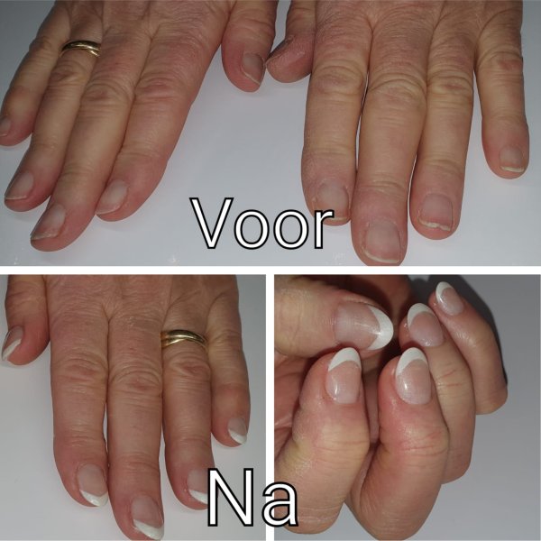 afbeelding nagelbijter