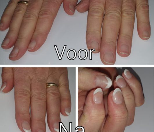 afbeelding nagelbijter
